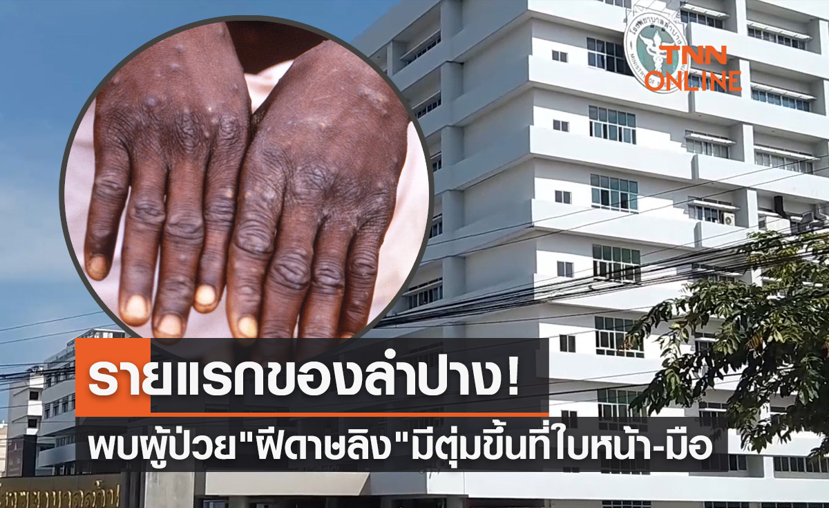 รายแรก! ลำปางพบผู้ป่วย "ฝีดาษลิง" มีตุ่มขึ้นที่ใบหน้า-มือทั้งสองข้าง