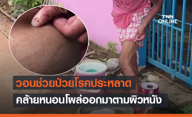 สาวใหญ่ป่วยโรคประหลาด! คล้ายหนอนโผล่ออกมาตามผิวหนัง