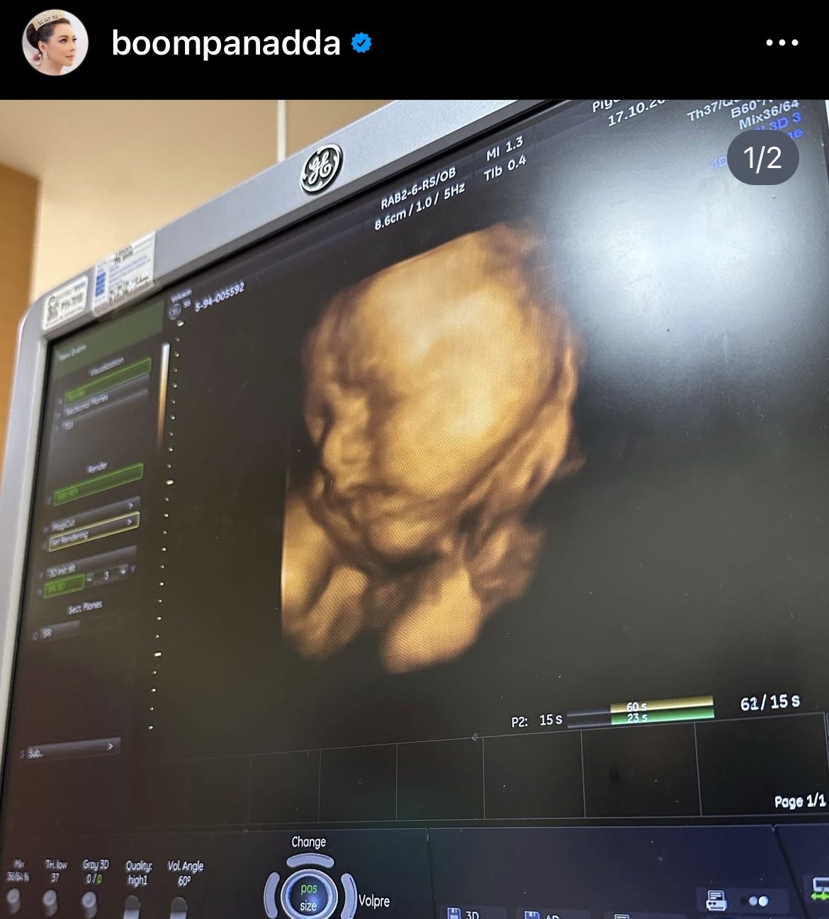 บุ๋ม ปนัดดา คลอดลูกชายแล้ว เวลา 11.11 น. บุ๋ม ปนัดดา คลอดลูกชายแล้ว เวลา 11.11 น.