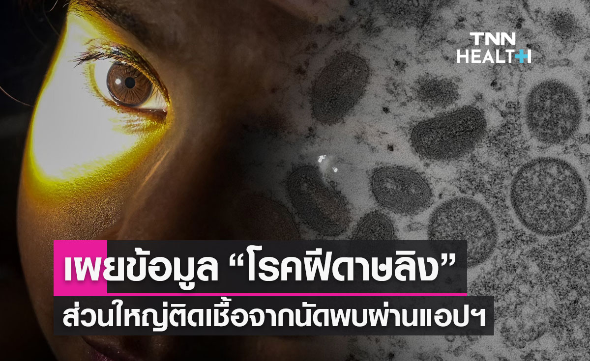 “โรคฝีดาษลิง” ส่วนใหญ่ติดเชื้อจากนัดพบผ่านแอปฯ ย้ำถุงยางป้องกันไม่ได้!