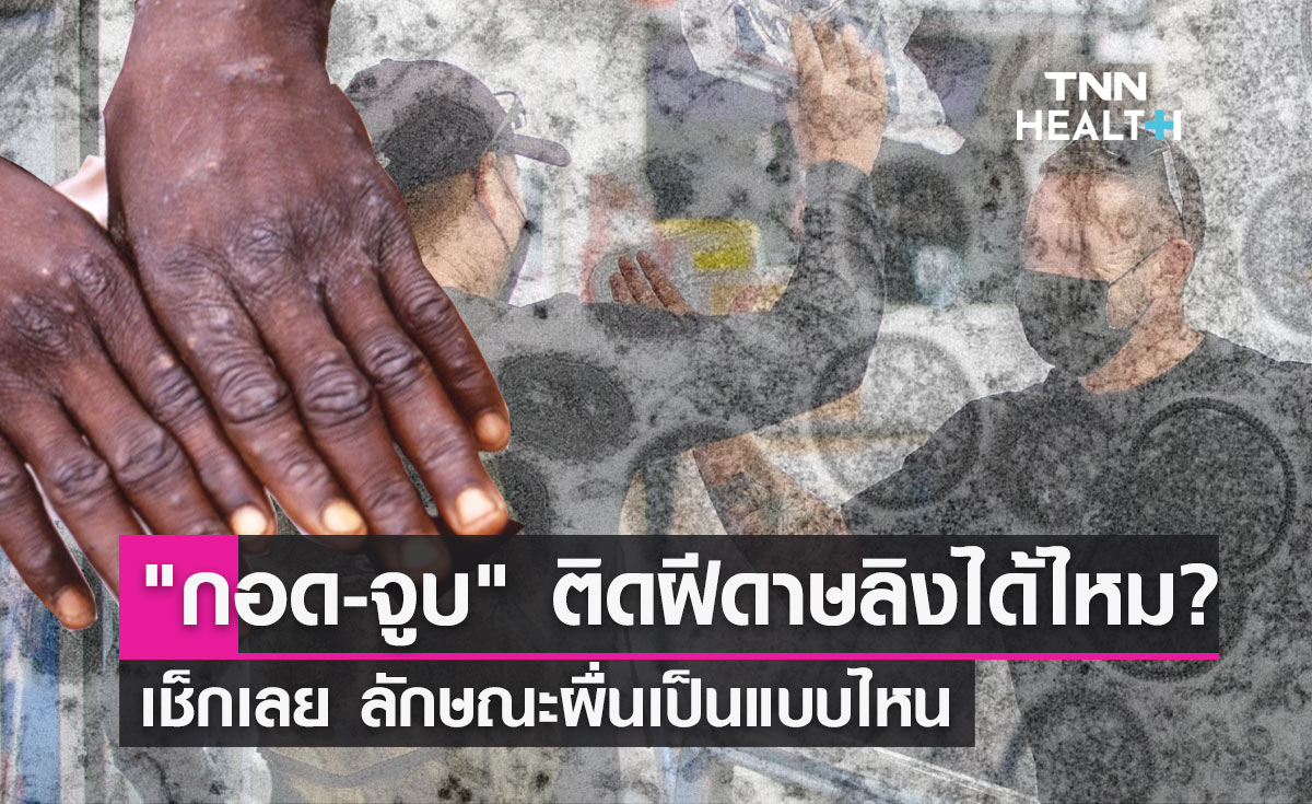 "กอดจูบ" ติดเชื้อฝีดาษลิงได้หรือไม่? เช็กเลยลักษณะผื่นเป็นแบบไหน