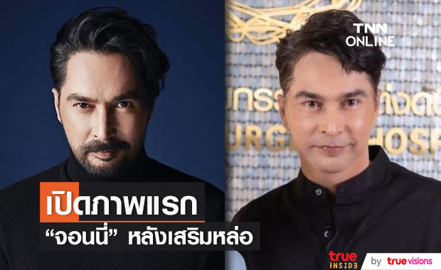 "จอนนี่ แอนโฟเน่" ทำศัลยกรรม แฟนคลับแห่ชม หน้าเด็กเหมือนเมื่อ 30 ปีก่อน