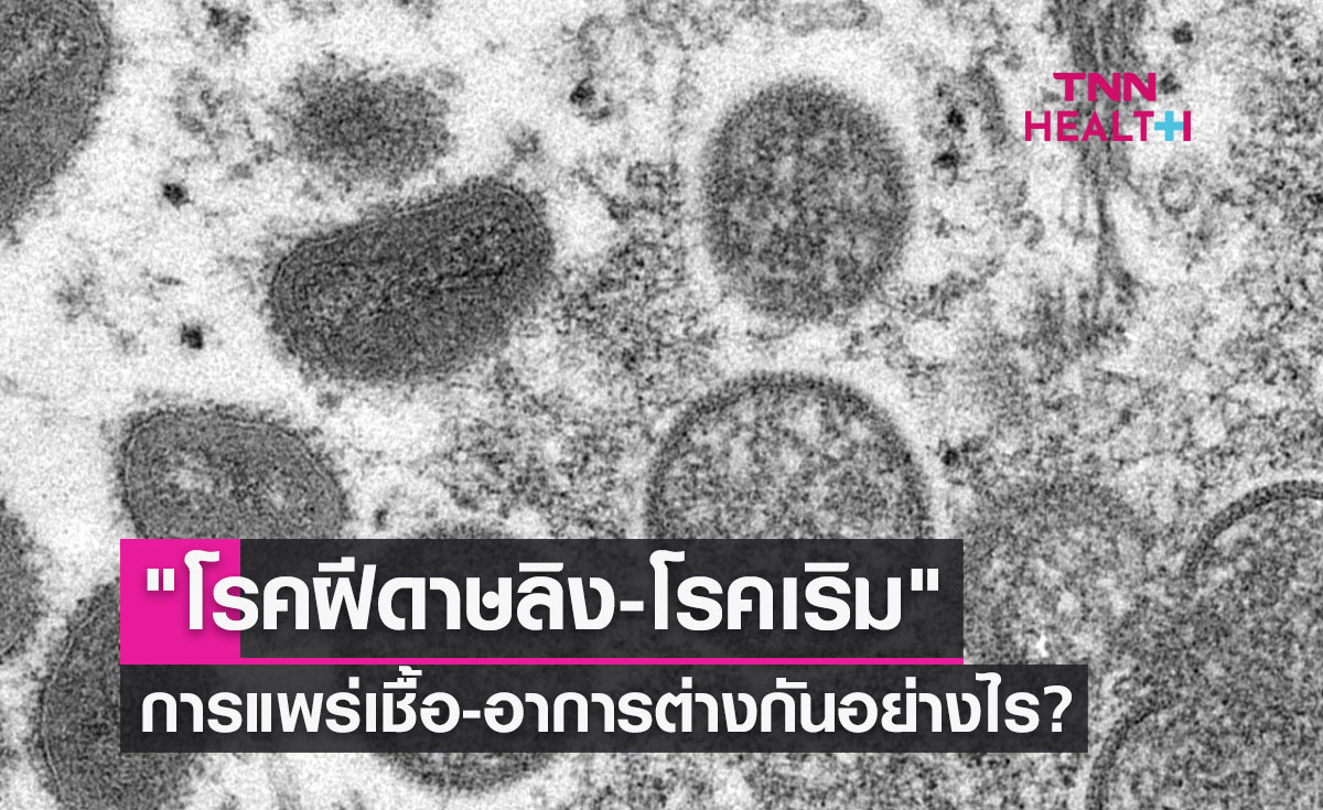 "โรคฝีดาษลิง" และ "โรคเริม" การแพร่เชื้อ-อาการ แตกต่างกันอย่างไร?