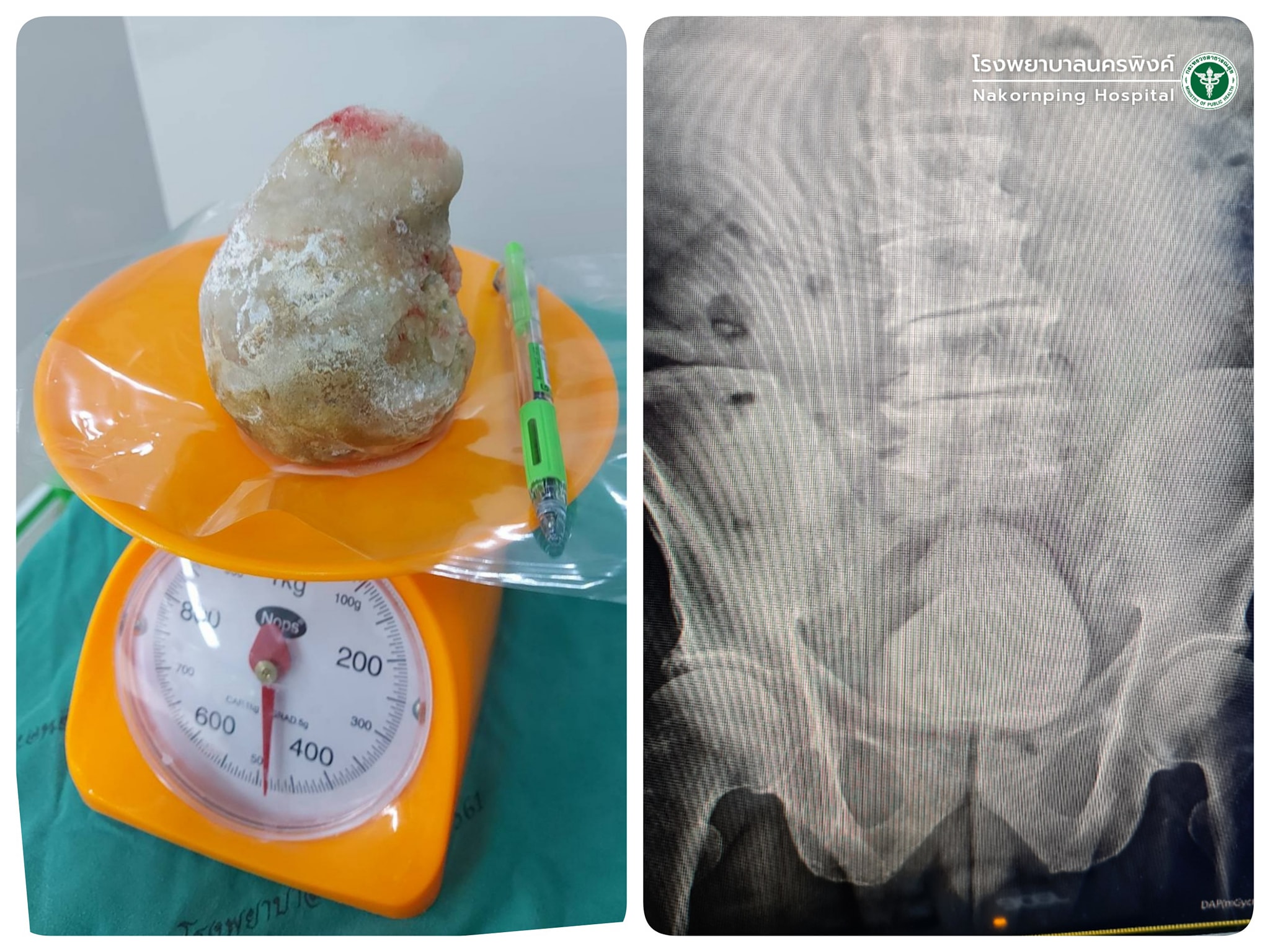 หมออึ้ง! ผู้ป่วยปัสสาวะติดขัดเจอนิ่วก้อนใหญ่หนักครึ่งกิโล หมออึ้ง! ผู้ป่วยปัสสาวะติดขัดเจอนิ่วก้อนใหญ่หนักครึ่งกิโล