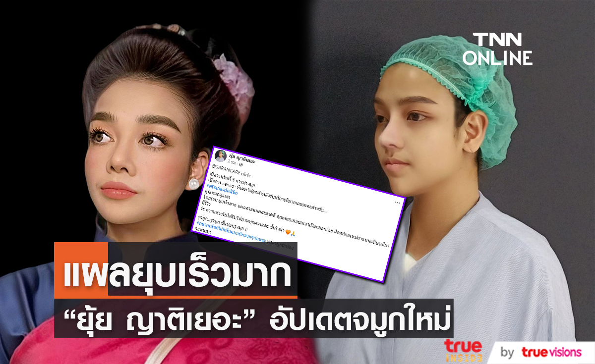 จมูกใหม่สวยมาก "ยุ้ย ญาติเยอะ" อัปเดตอาการหลังขึ้นเขียงทำศัลยกรรม ทำเอาจำแทบไม่ได้