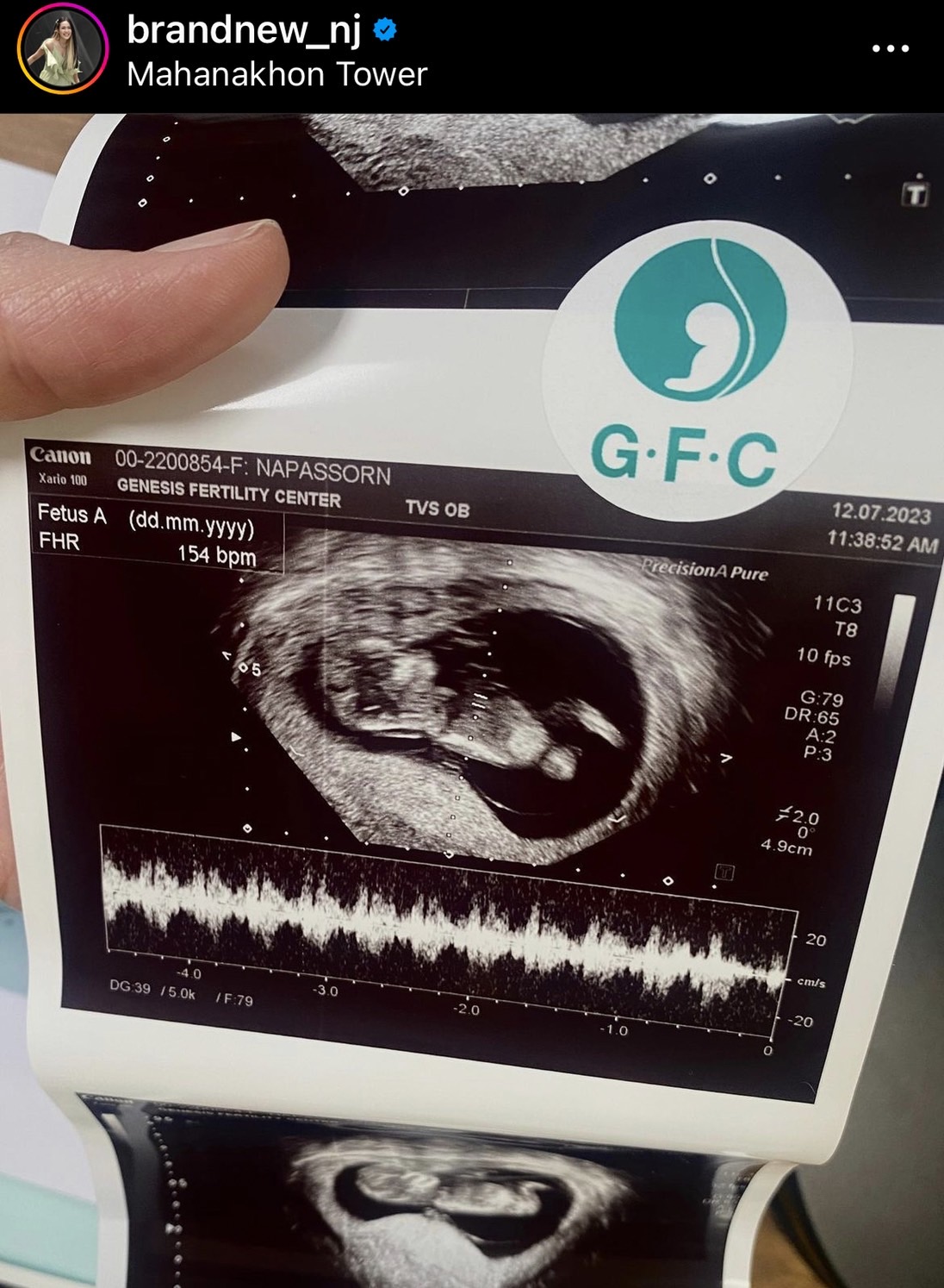 นิว-เป๊ก ประกาศข่าวดี เบบี๋มาแล้ว!!