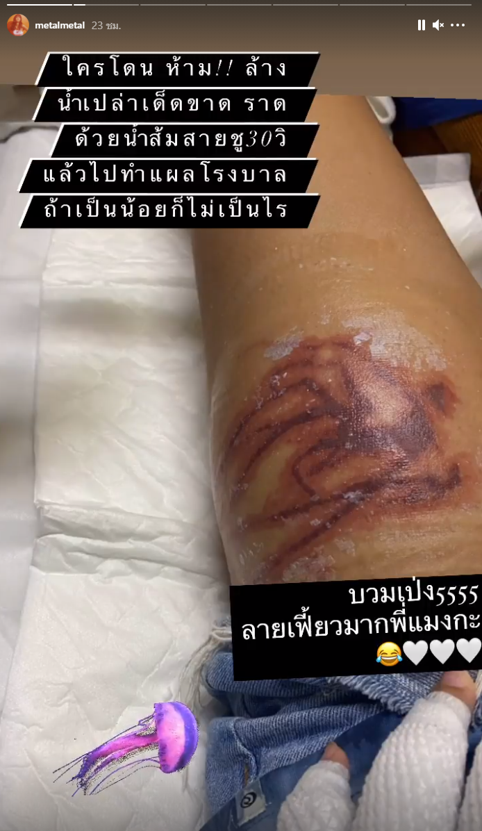 'เมทัล' โดนแมงกะพรุนไฟเล่นงาน จนเป็นแผลไหม้ทั้งแขน-ขา 'เมทัล' โดนแมงกะพรุนไฟเล่นงาน จนเป็นแผลไหม้ทั้งแขน-ขา
