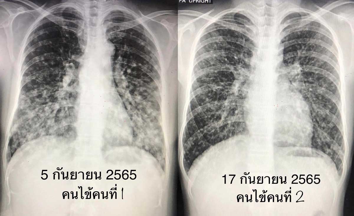 ชม ค้างคาว ในโพรงต้นไม้เจอเชื้อราในปอด ป่วยโรคฮีสโตพลาสโมสิส