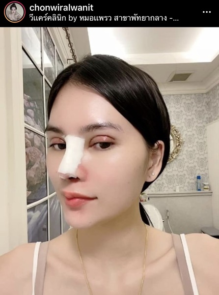 เอ๋ มิรา อัพความสวย ศัลยกรรมจมูก ตา และคาง เอ๋ มิรา อัพความสวย ศัลยกรรมจมูก ตา และคาง