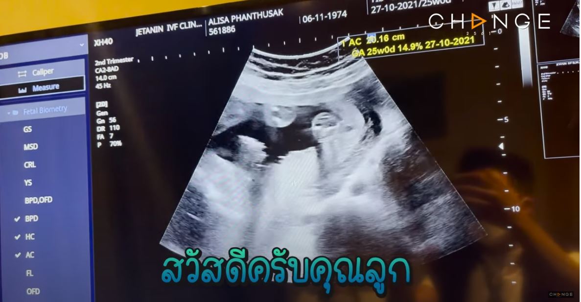 อั๋น ภูวนาท เฉลยเพศลูกคนที่ 2 แล้ว ได้ลูกชาย! พร้อมแจงสาเหตุปิดข่าวท้อง