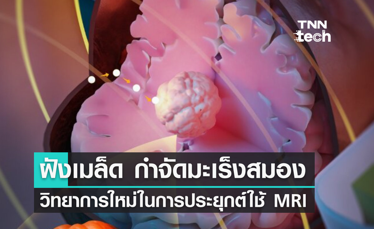 เทคโนโลยีใหม่ !! ฝังเมล็ดแม่เหล็ก - กำจัดมะเร็งสมอง ด้วย MRI