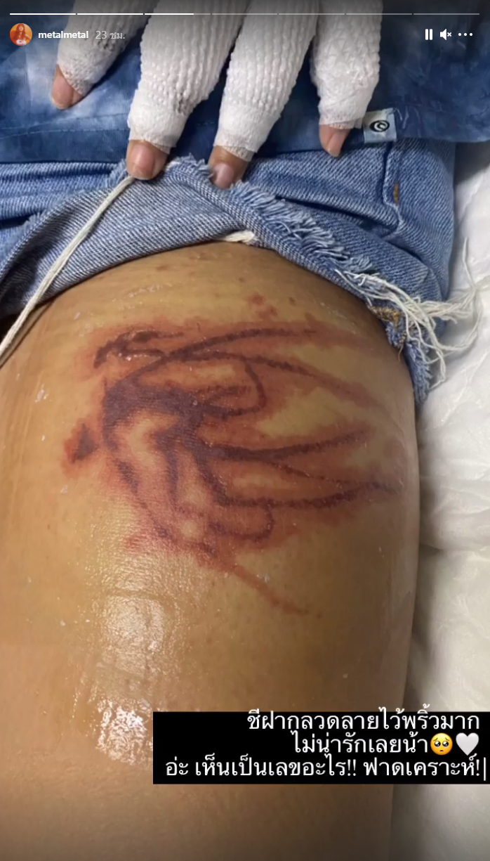 'เมทัล' โดนแมงกะพรุนไฟเล่นงาน จนเป็นแผลไหม้ทั้งแขน-ขา 'เมทัล' โดนแมงกะพรุนไฟเล่นงาน จนเป็นแผลไหม้ทั้งแขน-ขา