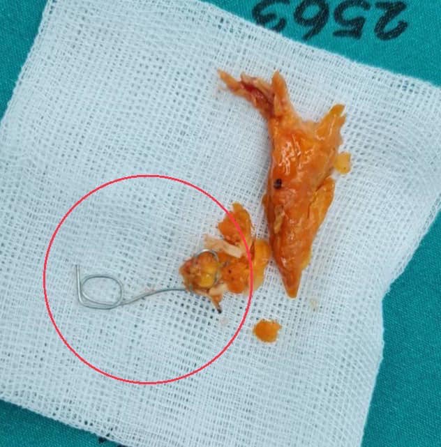 เคสอุทาหรณ์! เด็กกินไก่ย่างไม่ระวัง ลวดมัดติดหลอดอาหาร ต้องผ่าตัดด่วน เคสอุทาหรณ์! เด็กกินไก่ย่างไม่ระวัง ลวดมัดติดหลอดอาหาร ต้องผ่าตัดด่วน