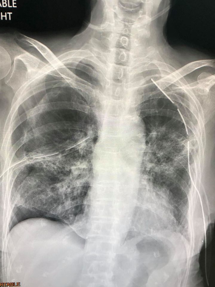 หมอมนูญ เปิดภาพเอ็กซเรย์ปอดผู้ป่วยโควิด ยังไม่ได้ฉีดวัคซีน ปอดรั่วทั้ง 2 ข้าง หมอมนูญ เปิดภาพเอ็กซเรย์ปอดผู้ป่วยโควิด ยังไม่ได้ฉีดวัคซีน ปอดรั่วทั้ง 2 ข้าง