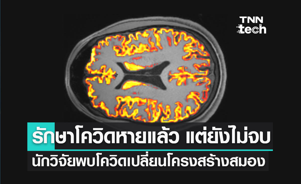 รักษาโควิดหายแล้ว แต่ยังไม่จบ ! นักวิจัยพบโควิดเปลี่ยนแปลงโครงสร้างสมองด้วย