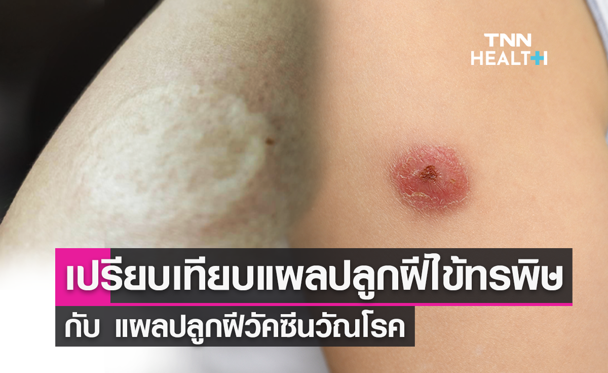 เปรียบเทียบแผลปลูกฝีดาษและแผลวัคซีนวัณโรคต่างกันอย่างไร