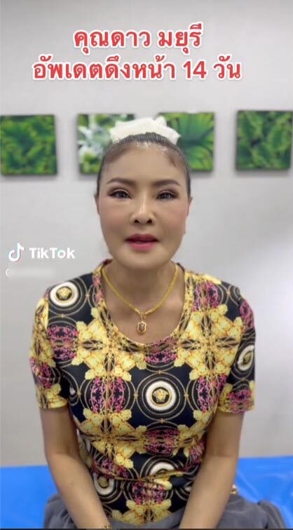 ตะลึงความสวย! ดาว มยุรี อัปเดตหน้าใหม่หลังทำศัลยกรรมครบ 14 วัน ตะลึงความสวย! ดาว มยุรี อัปเดตหน้าใหม่หลังทำศัลยกรรมครบ 14 วัน