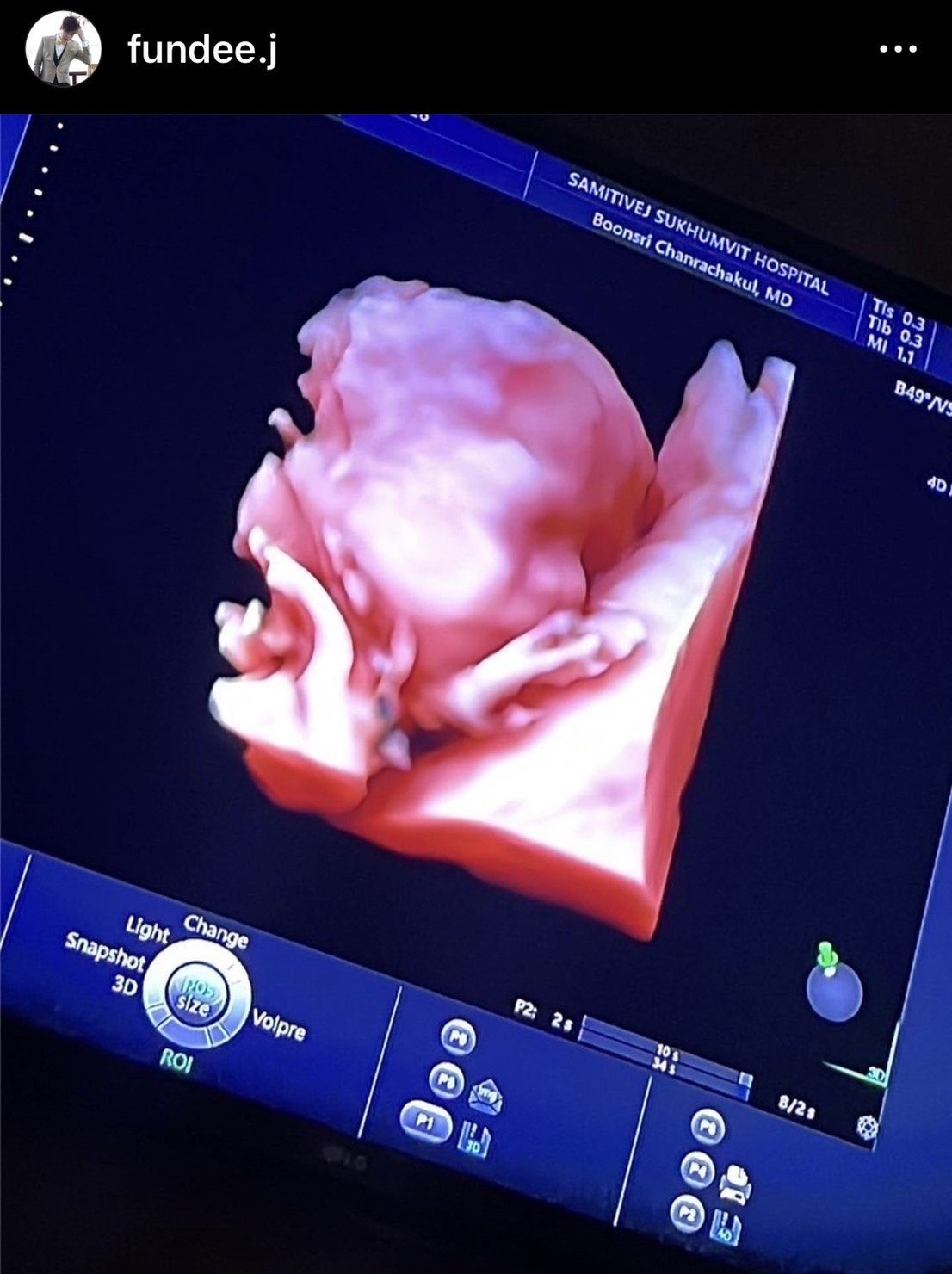 คุณตาฝันดี ดีใจมาก! จินนี่ ลูกสาวตั้งท้องทายาทคนแรก คุณตาฝันดี ดีใจมาก! จินนี่ ลูกสาวตั้งท้องทายาทคนแรก