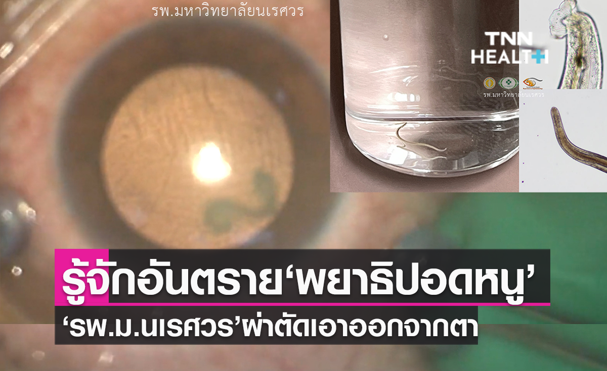 รู้จัก’พยาธิปอดหนู’ กินสุกๆ ดิบๆ ก่อให้เกิดโรค อันตรายถึงชีวิต