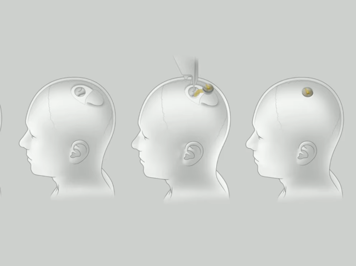 อัปเกรดสมอง วิวัฒนาการขั้นสุดยอดของมวลมนุษย์ ด้วยชิป Neuralink อัปเกรดสมอง วิวัฒนาการขั้นสุดยอดของมวลมนุษย์ ด้วยชิป Neuralink