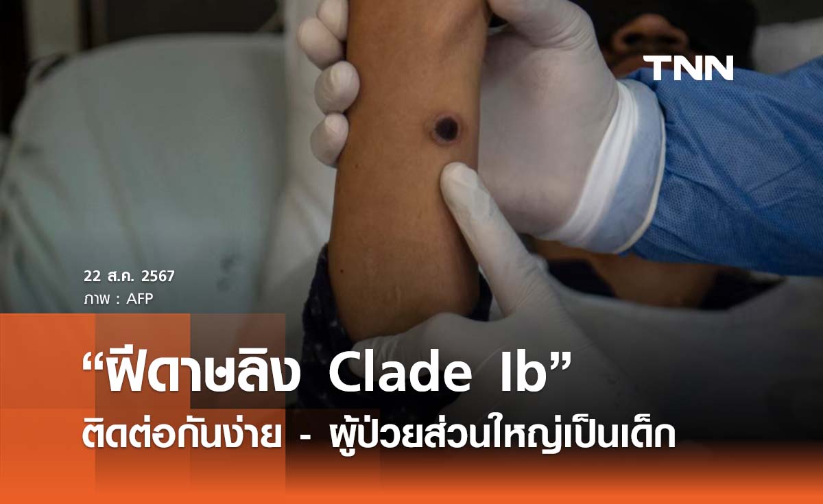 หมอยงเผย “ฝีดาษลิง Clade Ib” ติดกันง่าย - ผู้ป่วยส่วนใหญ่เป็นเด็ก