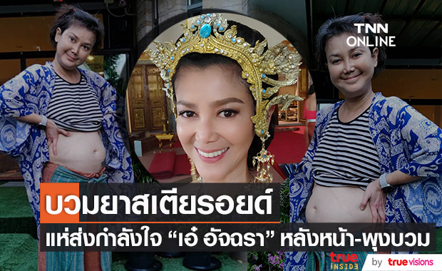 ส่งกำลังใจอดีตดารา "เอ๋ อัจฉรา" หน้า-พุงบวมยาสเตียรอยด์ และภาวะน้ำท่วมปอด