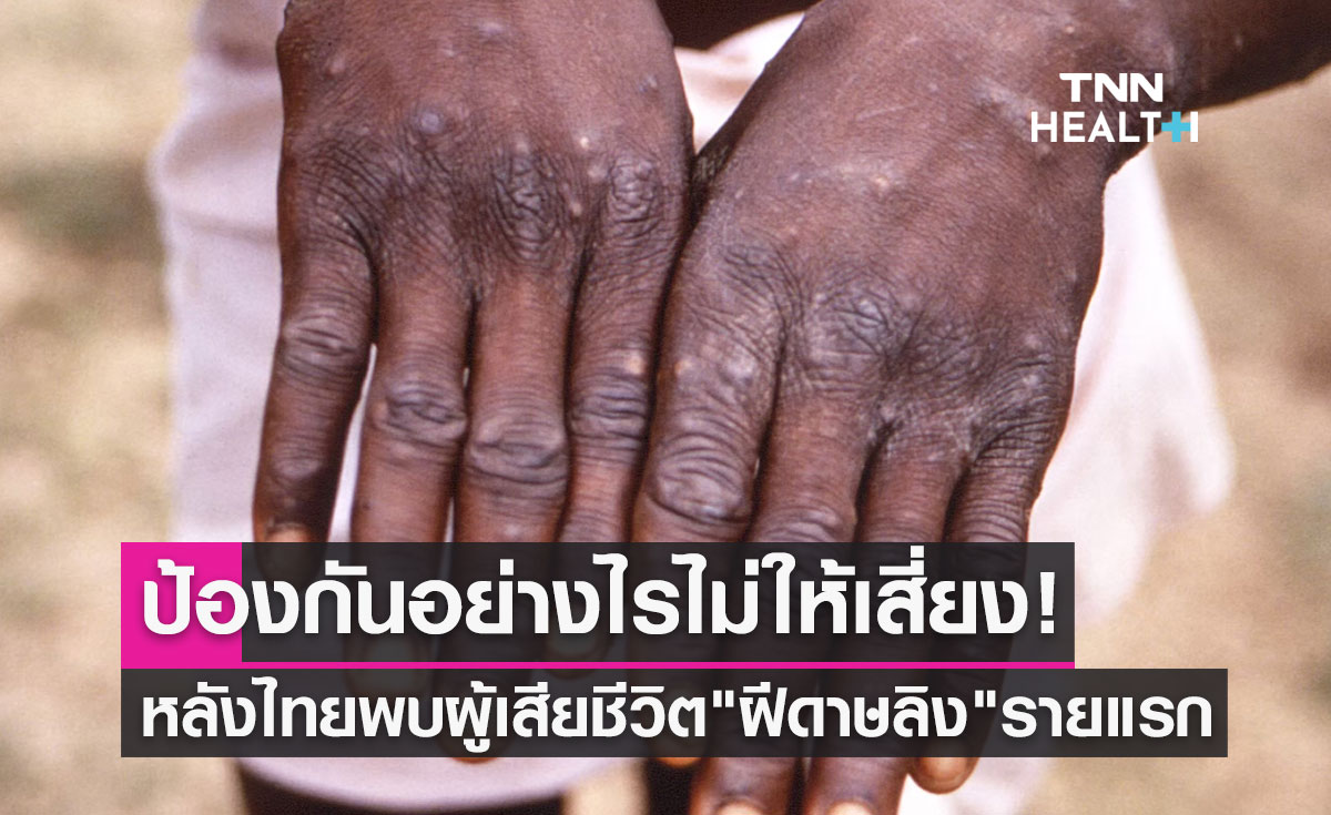 "ฝีดาษลิง" ป้องกันตัวเองอย่างไรไม่ให้เสี่ยง! หลังไทยพบผู้เสียชีวิตรายแรก