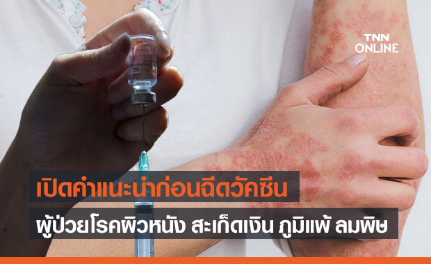 เปิดคำแนะนำผู้ป่วยโรคผิวหนัง สะเก็ดเงิน ภูมิแพ้ ลมพิษ ก่อนฉีดวัคซีนโควิด-19