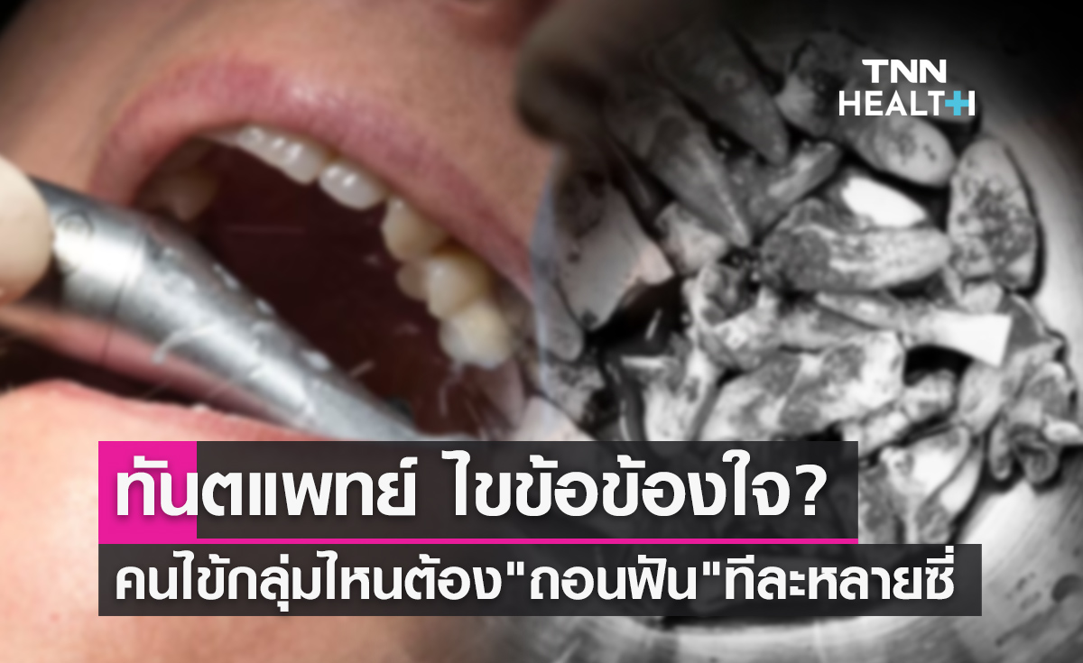 ทันตแพทย์ ไขข้อข้องใจ? คนไข้กลุ่มไหนต้องเร่ง "ถอนฟัน" ทีละหลายๆซี่