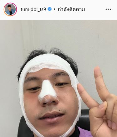 เฉลยแล้ว!! ตั้ม วราวุธ ทำศัลยกรรมใบหน้าจริงไหม?