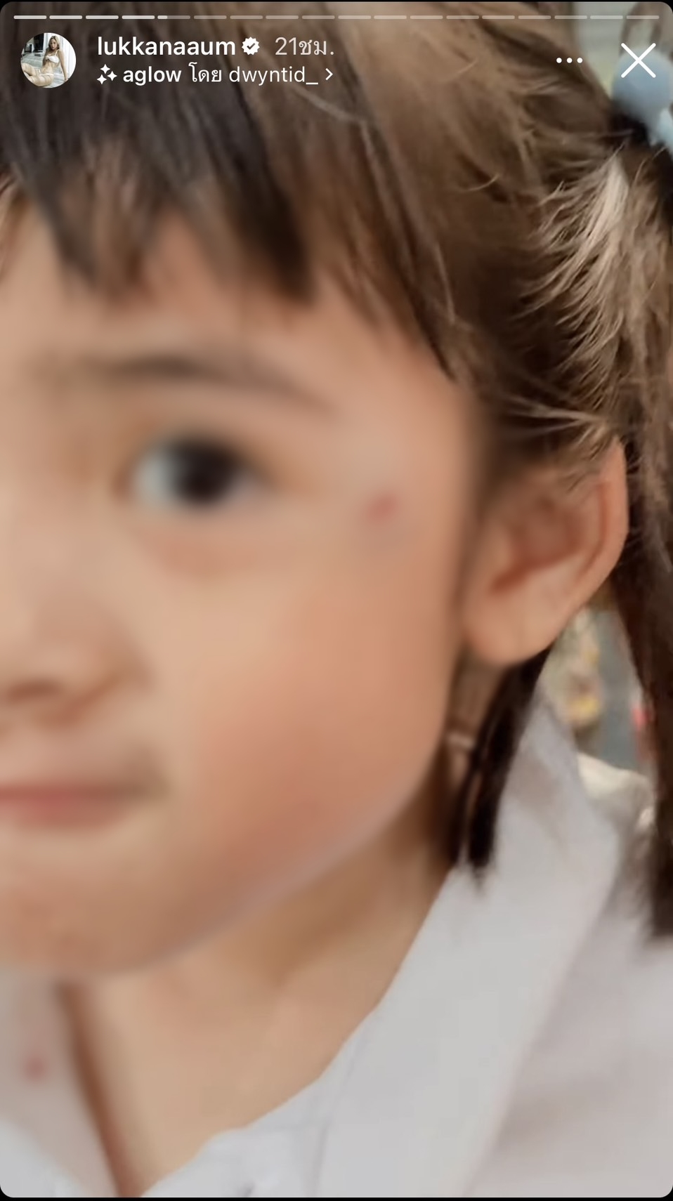น้องดิสนีย์ ลูกสาว อุ้ม ลักขณา ได้รับบาดเจ็บ