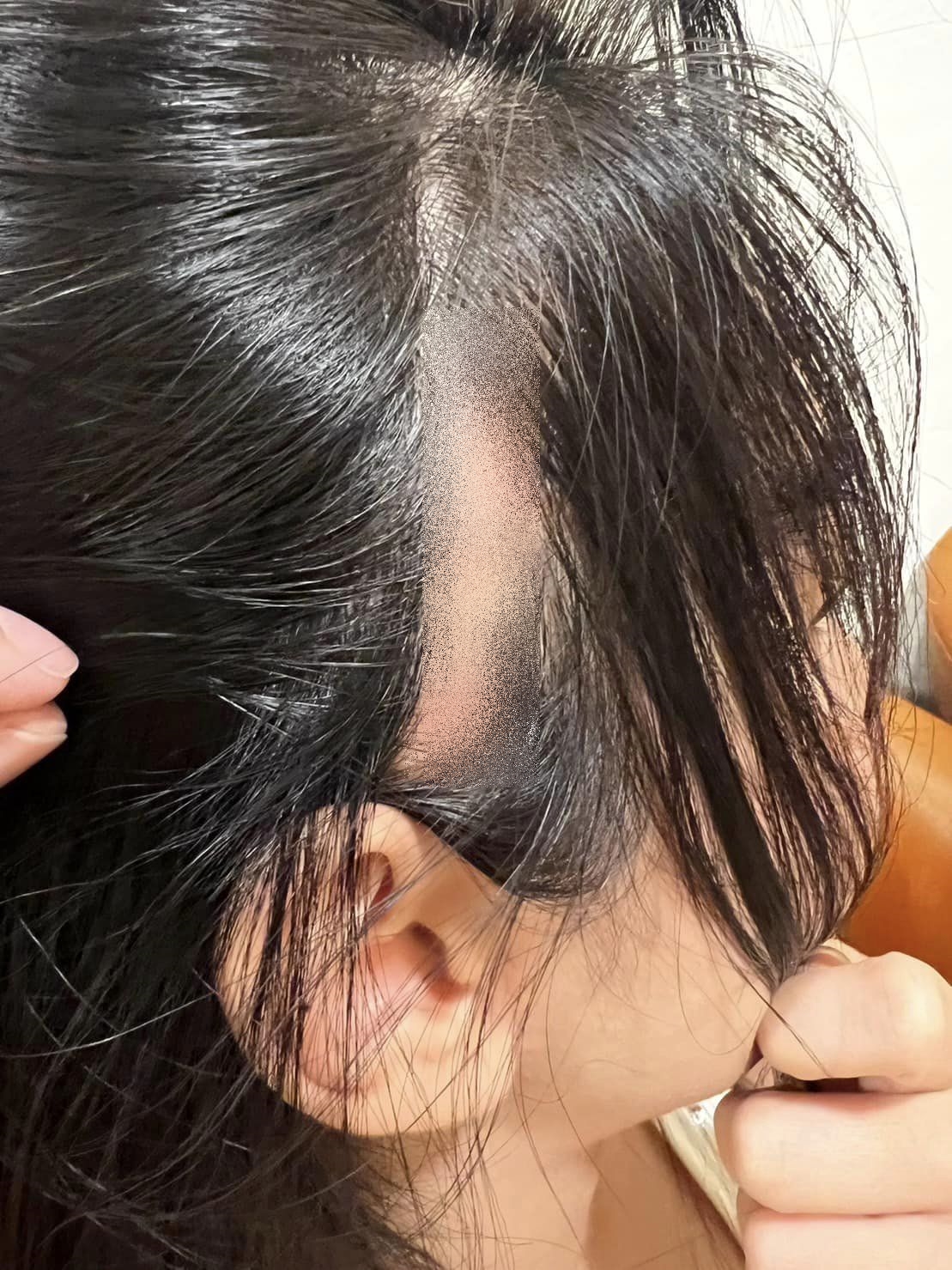 ศัลยกรรมสยอง! น้ำเพชร ฏีญาร์ภา หนังศรีษะเปิด หลังขึ้นเขียงทำสวย