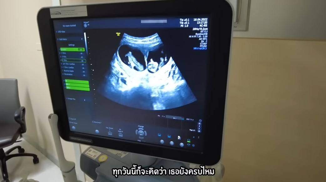 เปิดใจ บีม กวี ว่าที่คุณพ่อลูก 4 ยลโฉมเบบี๋ฝาแฝดท้อง 2 เผย ภรรยา แพ้ท้องหนัก เปิดใจ บีม กวี ว่าที่คุณพ่อลูก 4 ยลโฉมเบบี๋ฝาแฝดท้อง 2 เผย ภรรยา แพ้ท้องหนัก