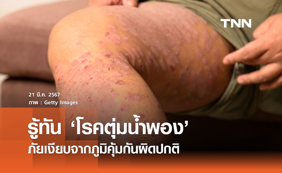 โรคตุ่มน้ำพอง : ภัยเงียบจากภูมิคุ้มกันผิดปกติ  รู้เท่าทัน ดูแลรักษา ป้องกันกำเริบ 