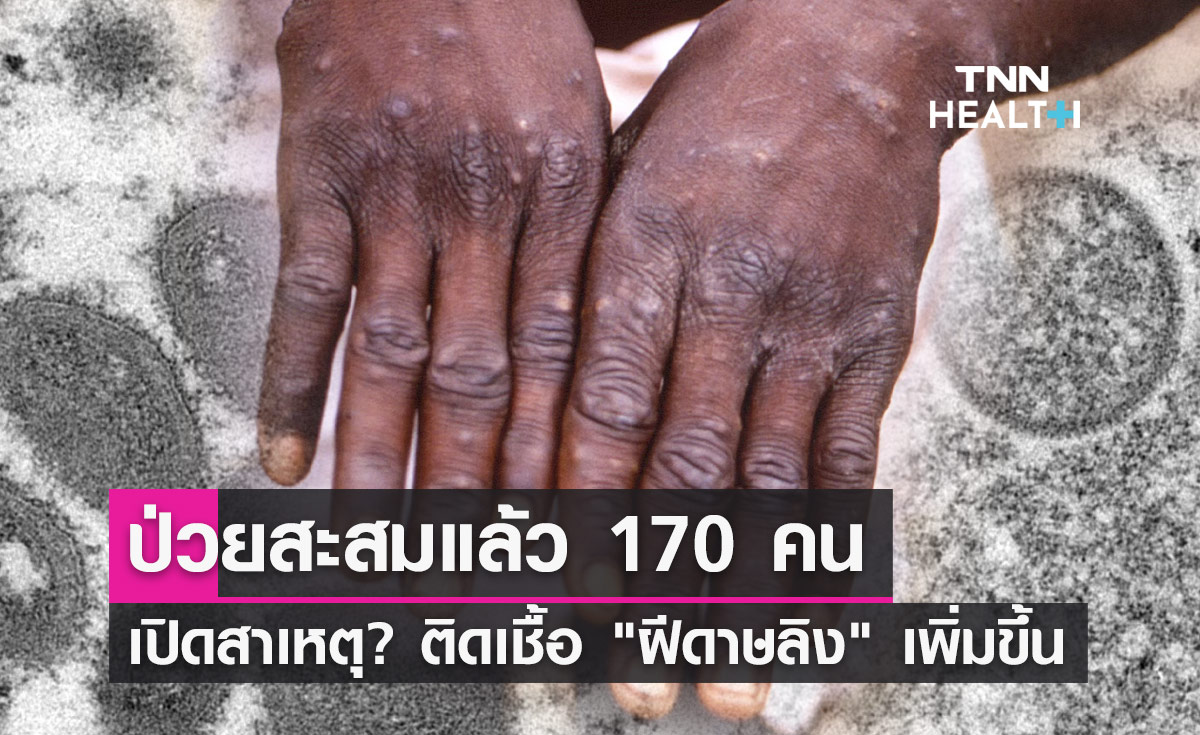 ไทยพบผู้ป่วย "ฝีดาษลิง" สะสมแล้ว 170 คน สาเหตุติดเชื้อเพิ่มขึ้นเพราะอะไร?