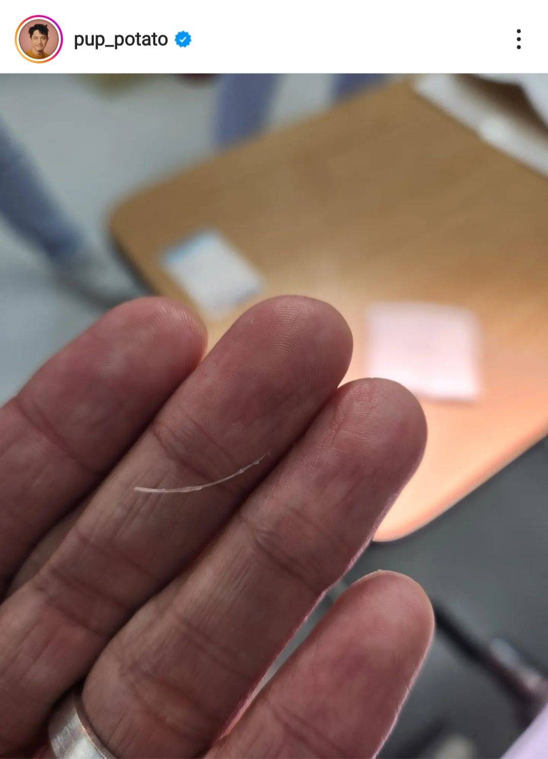 ปั๊บ โปเตโต้ แชร์ประสบการณ์ ก้างติดคอ ต้องล้วงคอลึกมาก ปั๊บ โปเตโต้ แชร์ประสบการณ์ ก้างติดคอ ต้องล้วงคอลึกมาก