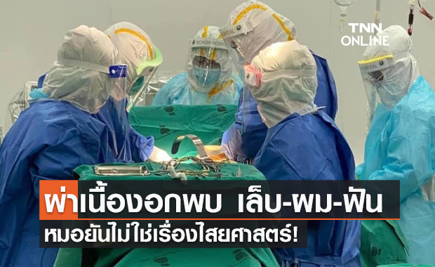 ไม่ใช่ไสยศาสตร์! หมอผ่าตัดเนื้องอกสาววัย 17 ปีเจอ"ผม-เล็บ-ฟัน"