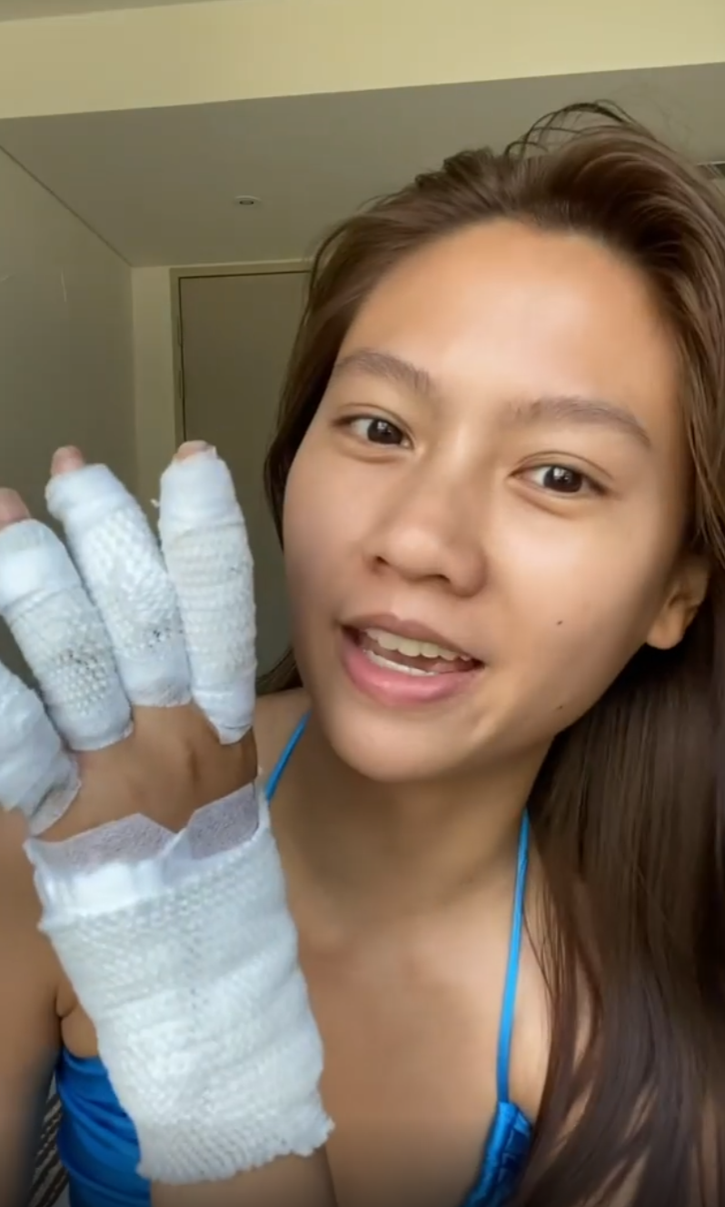 'เมทัล' โดนแมงกะพรุนไฟเล่นงาน จนเป็นแผลไหม้ทั้งแขน-ขา 'เมทัล' โดนแมงกะพรุนไฟเล่นงาน จนเป็นแผลไหม้ทั้งแขน-ขา