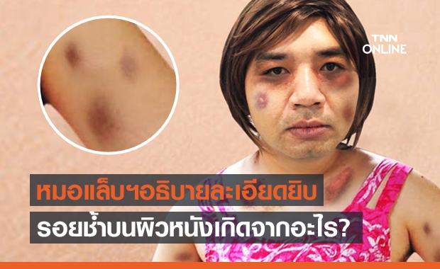"หมอแล็บแพนด้า" ไขข้อสงสัย รอยช้ำบนผิวหนังเกิดจากอะไร?