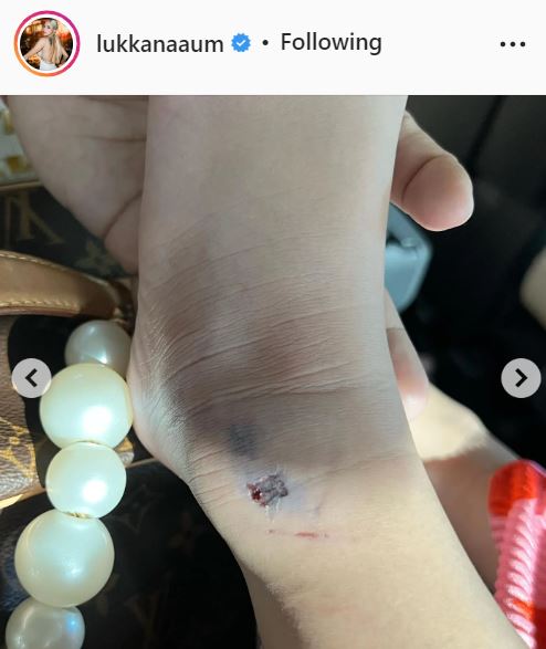 อุ้ม ลักขณา สุดห่วง ลูกสาว น้องดิสนีย์ เท้าหลุดเข้าไปในล้อจักรยาน
