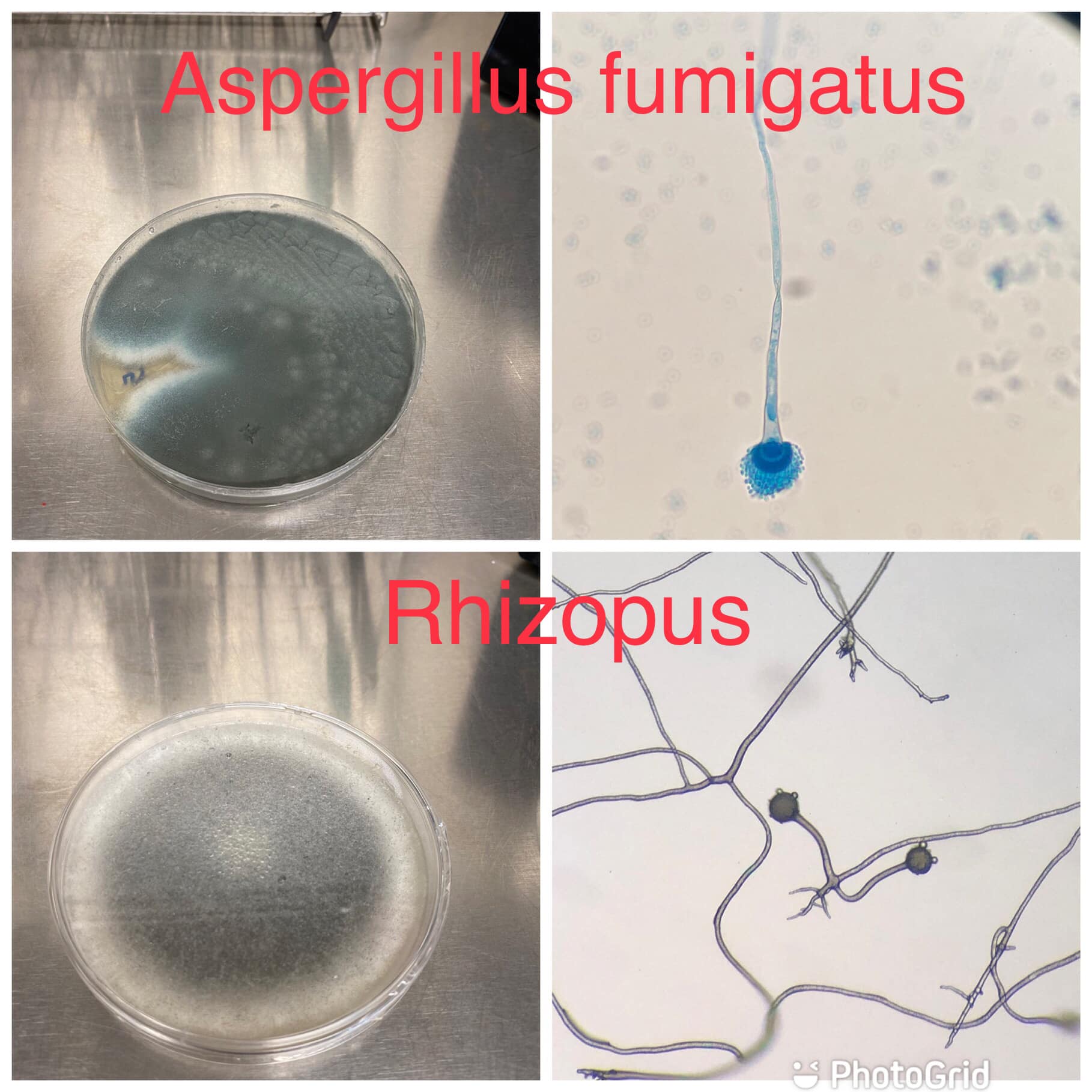 หมอมนูญเผยเคสผู้ป่วย “ปอดติดเชื้อจากราในเมล็ดข้าวโพด” หมอมนูญเผยเคสผู้ป่วย “ปอดติดเชื้อจากราในเมล็ดข้าวโพด”