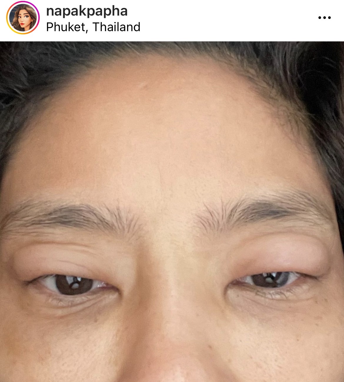 มะหมี่ นภคปภา เกิดอาการแพ้น้ำยาซักผ้ารุนแรง ถึงขั้นหายใจไม่ออก ตาบวม 