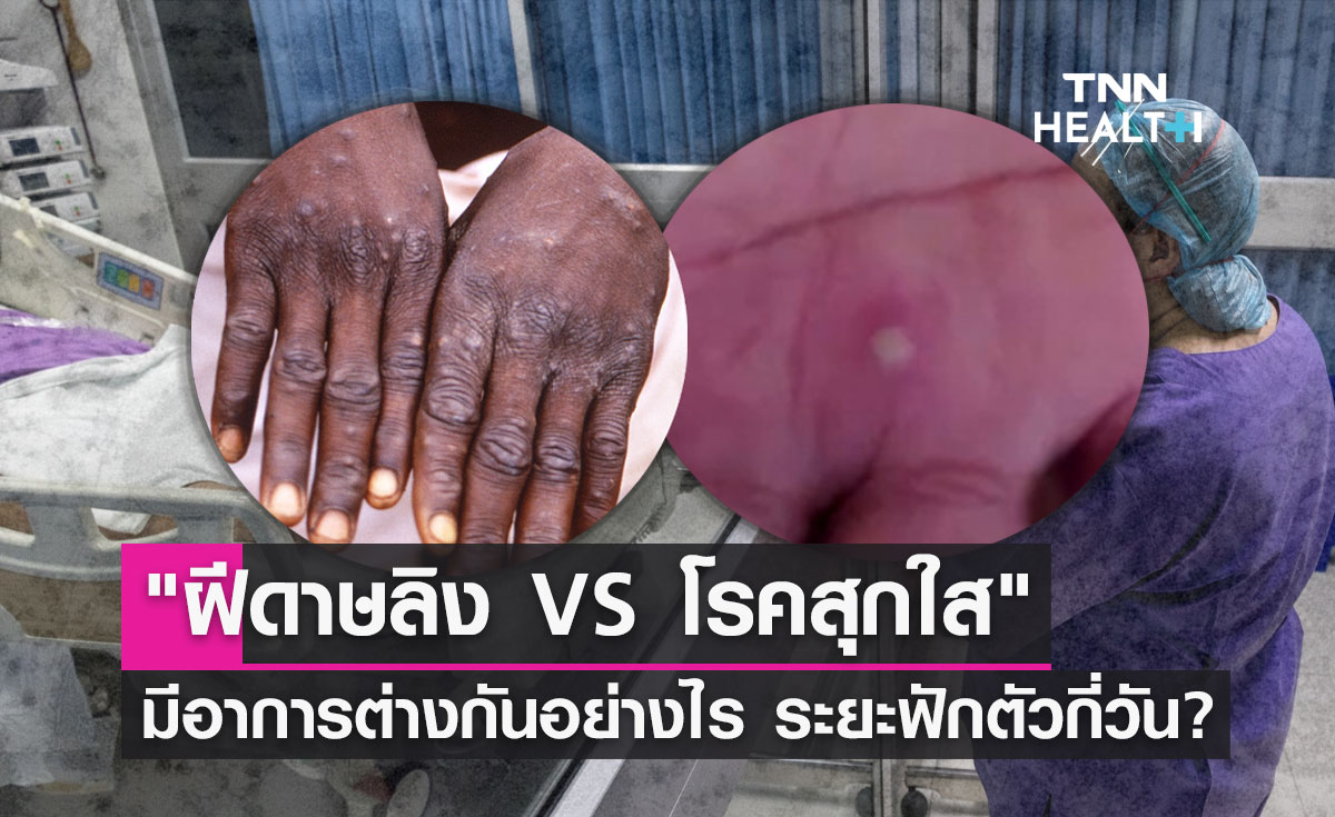 "ฝีดาษลิง VS โรคสุกใส" มีอาการต่างกันอย่างไร ระยะฟักตัวกี่วัน?