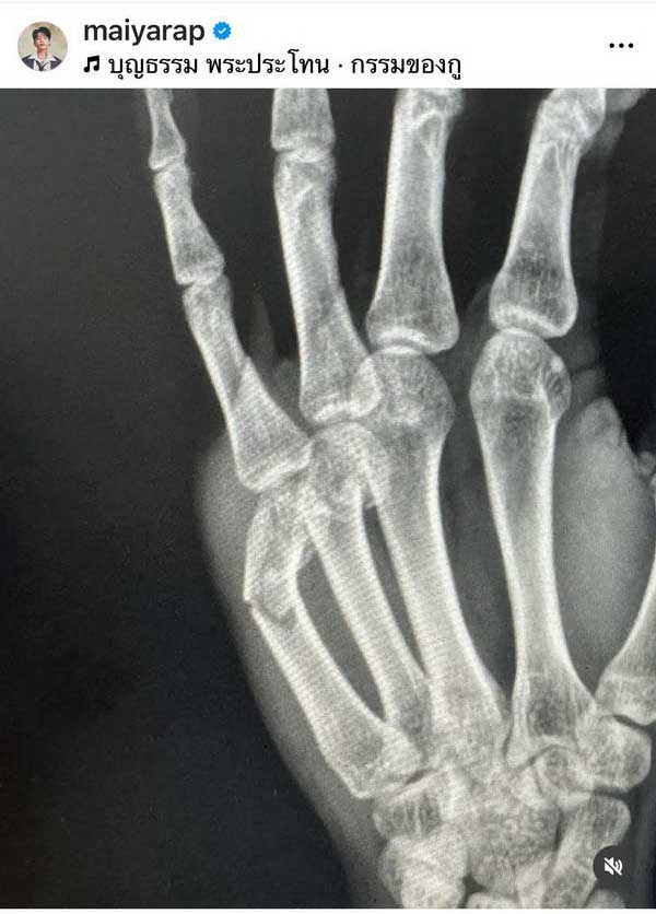 แชมป์ ไมยราพ แร็ปเปอร์ดัง กระดูกมือแตก เพื่อนศิลปินแห่ส่งกำลังใจ แชมป์ ไมยราพ แร็ปเปอร์ดัง กระดูกมือแตก เพื่อนศิลปินแห่ส่งกำลังใจ