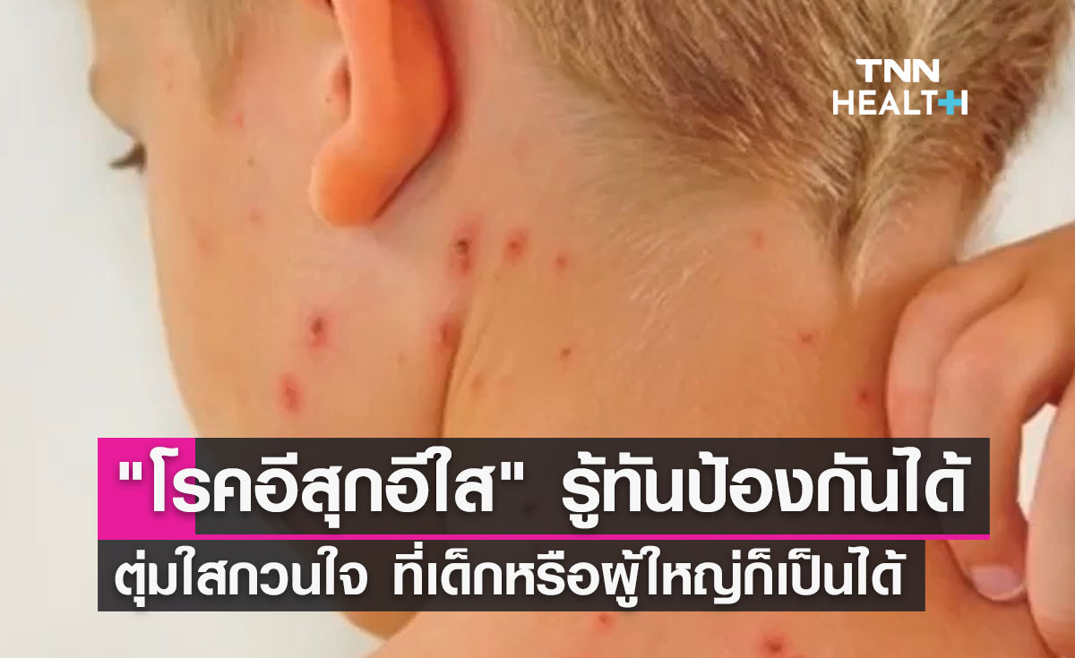 "โรคอีสุกอีใส" รู้ทันป้องกันได้ ตุ่มใสกวนใจ ที่เด็กหรือผู้ใหญ่ก็เป็นได้