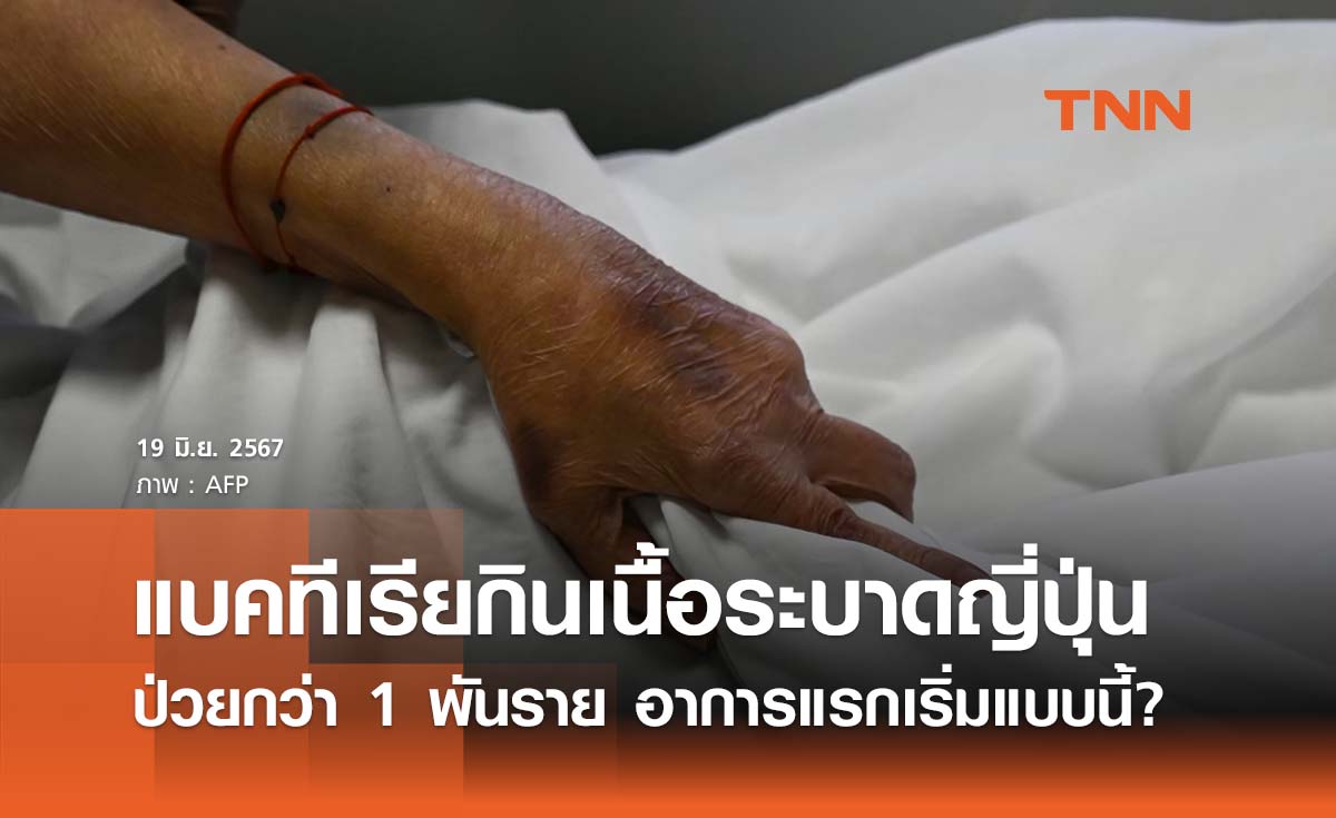 “โรคแบคทีเรียกินเนื้อ ” ระบาดญี่ปุ่นป่วยมากกว่า 1 พันราย อาการแรกเริ่มแบบนี้?