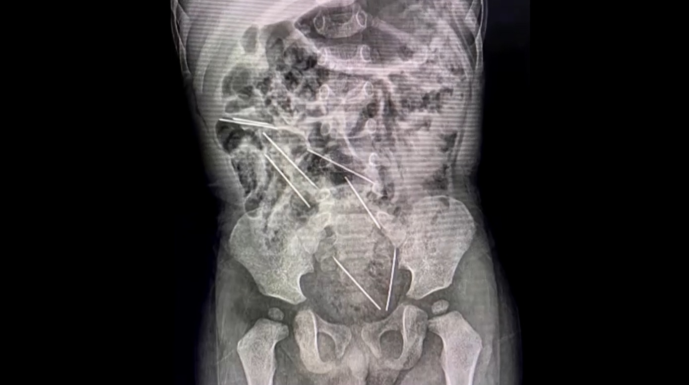 ผ่าตัดช่วยชีวิต! เด็กชายเปรูวัย 2 ขวบกลืนเข็มฉีดยา 8 เล่มลงท้อง