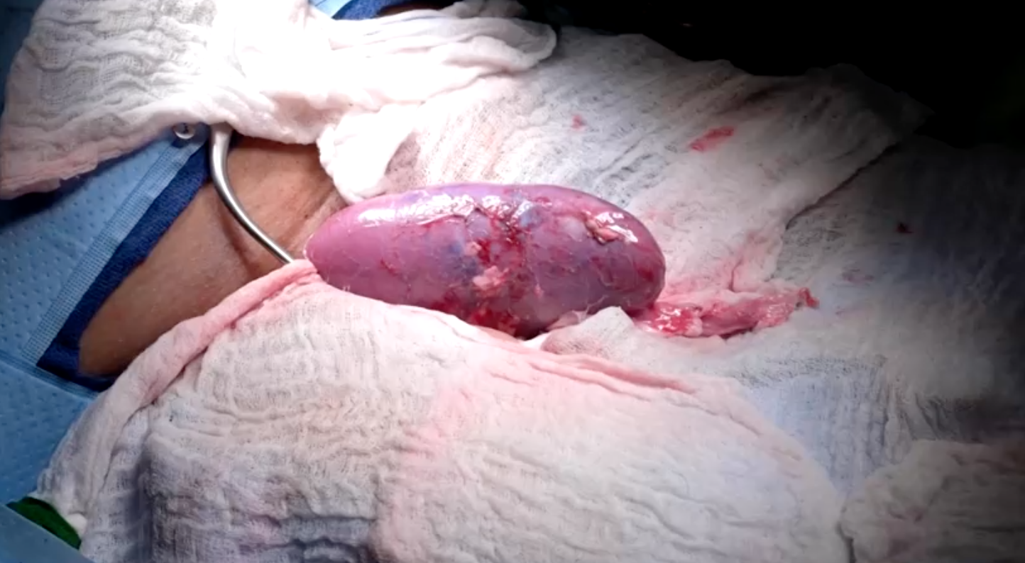 แพทย์สหรัฐฯปลูกถ่ายไตของหมูในมนุษย์สำเร็จเป็นครั้งแรก 