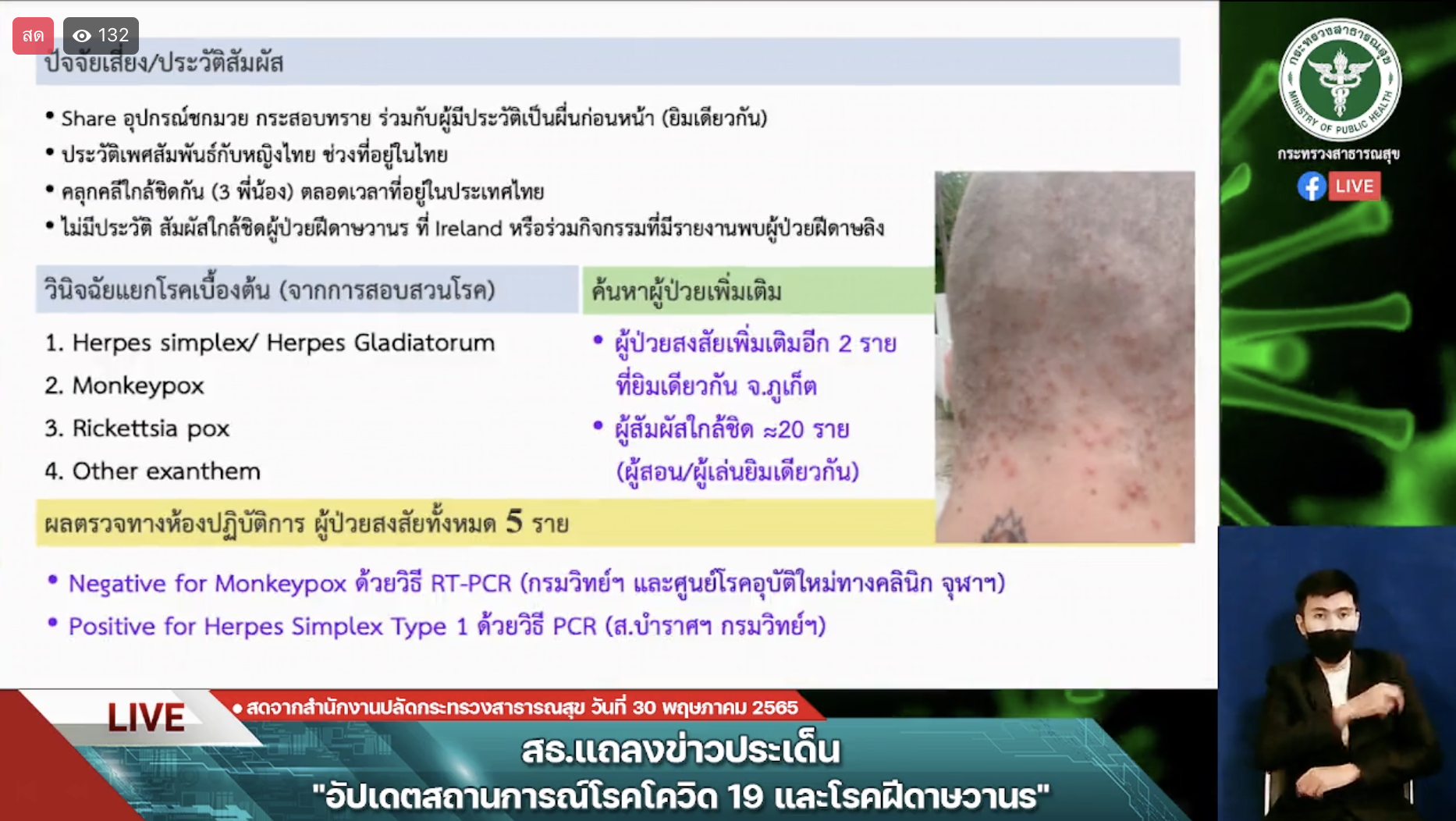 ยืนยันไทยยังไม่พบผู้ป่วยโรคฝีดาษลิง ติดตาม 12 รายใกล้ชิดผู้ป่วยระหว่าเดินทาง ยังปลอดภัย