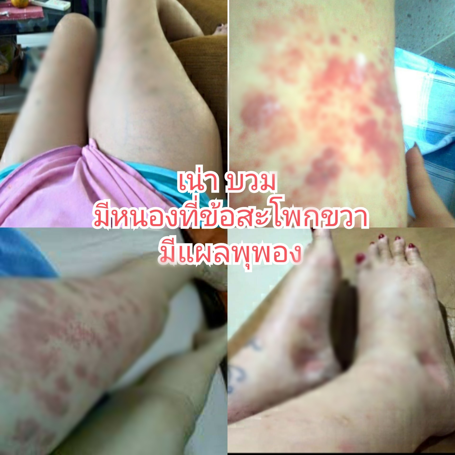 รอดตายครั้งล่าสุด!! อดีตดารา เอ๋ อัจฉรา หัวใจ-ไตวายเฉียบพลัน ทำ SLE มะเร็ง เบาหวานกำเริบ